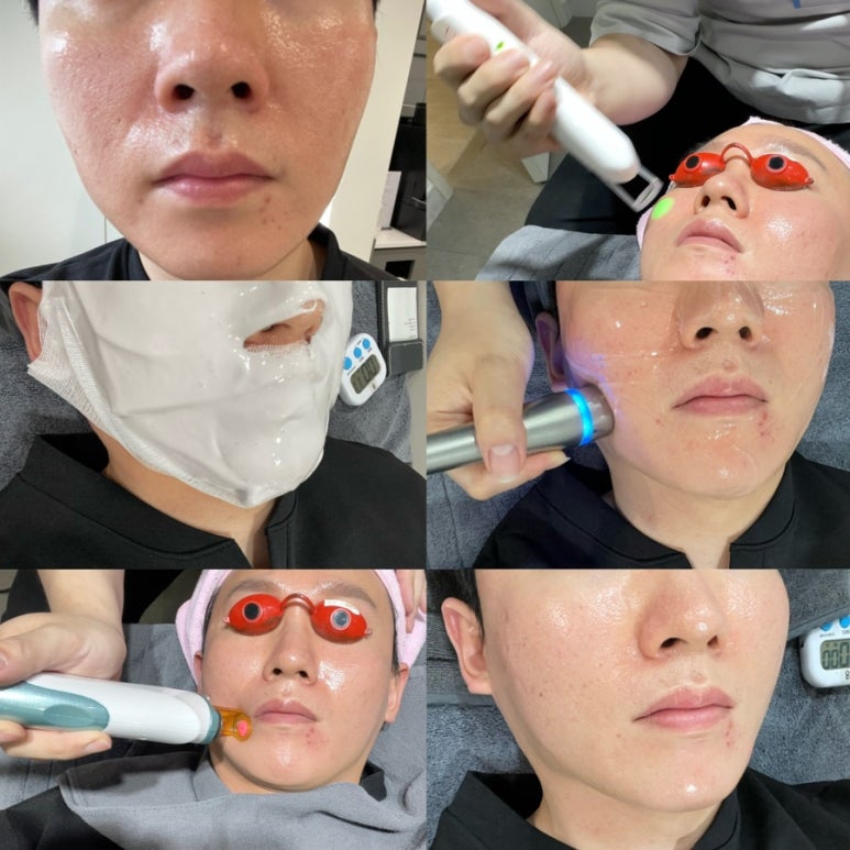 Bellvue Clinic Excel V Laser Treatment A to Z image 11