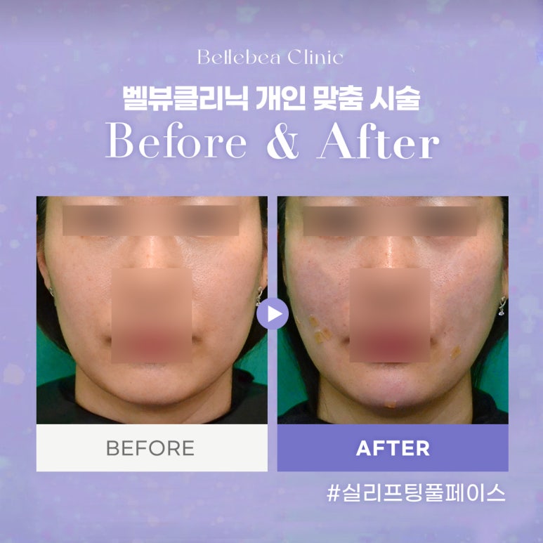 벨뷰클리닉 개인 맞춤 시술 관련 이미지 1