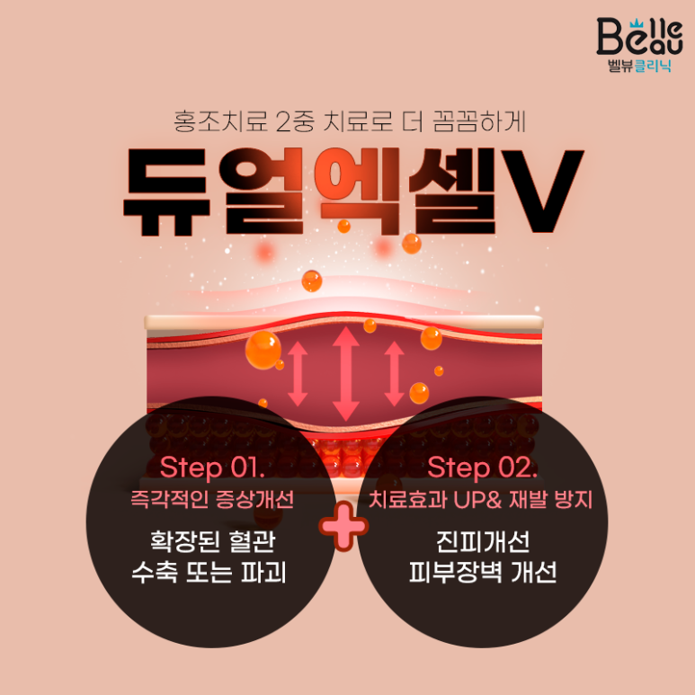 홍조치료 레이저 엑셀v를 이용한 안면홍조 치료와 효과 관련 이미지 4