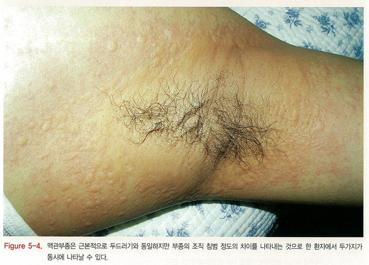 다양한 두드러기 종류 1탄 (알레르기성/ 만성특발성/ 한랭성/ 열성/ 피부묘기증 등) 관련 이미지 4
