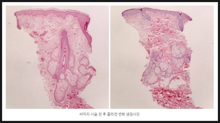 [ 닥터벨뷰 칼럼 88.] 고주파, 초음파, 극초단파 리프팅의 비교 관련 이미지 4