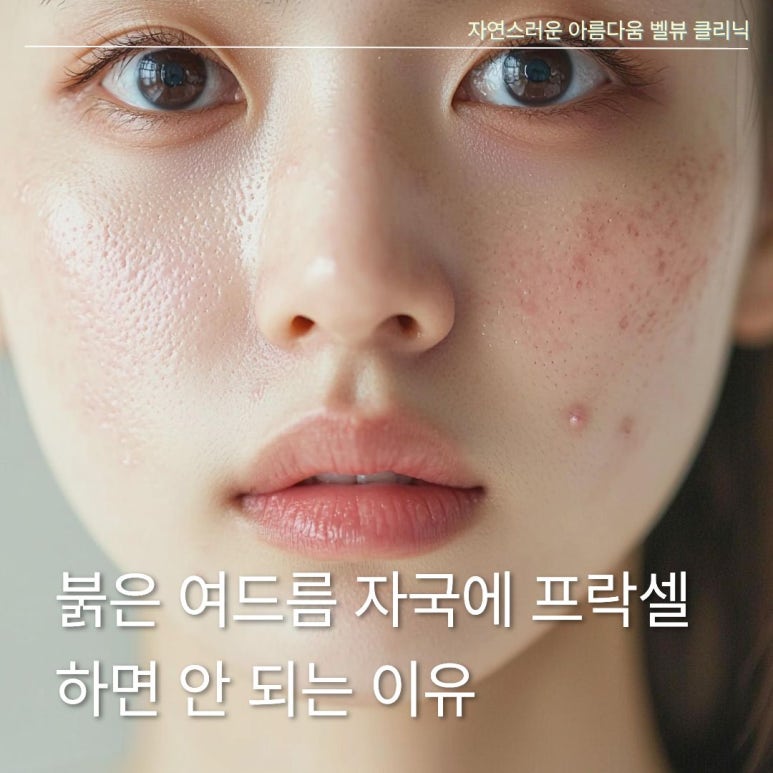 여드름 자국과 여드름 흉터 구별법, 프락셀을 맞으면 좋은 경우와 안 좋은 경우는? 관련 이미지 3