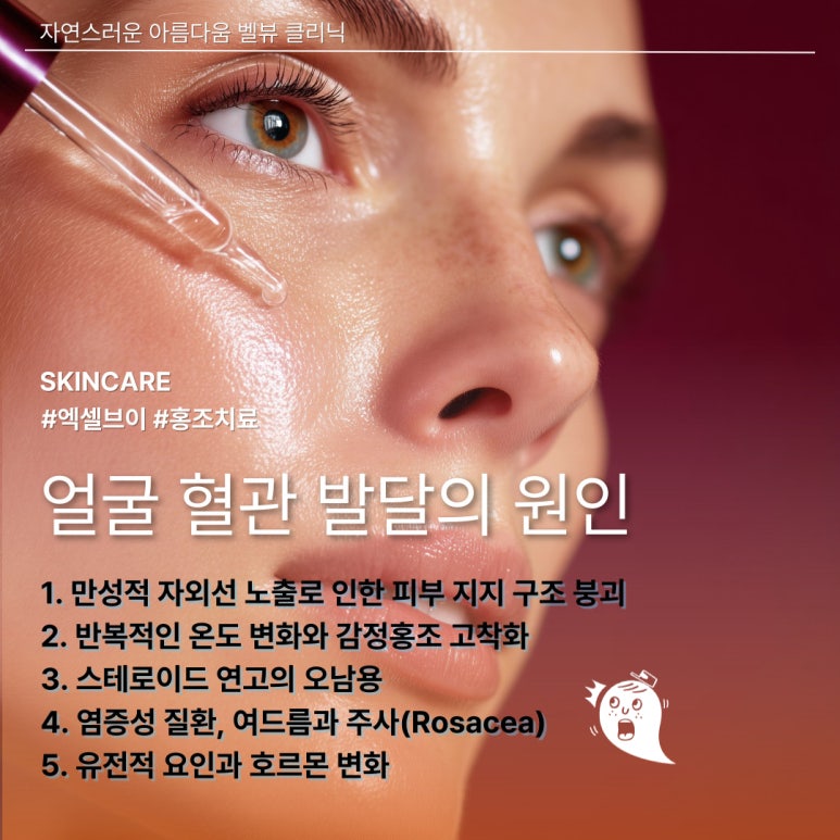 얼굴 실핏줄 만성 홍조 치료, 혈관 문제는 엑셀브이가 정답 관련 이미지 2