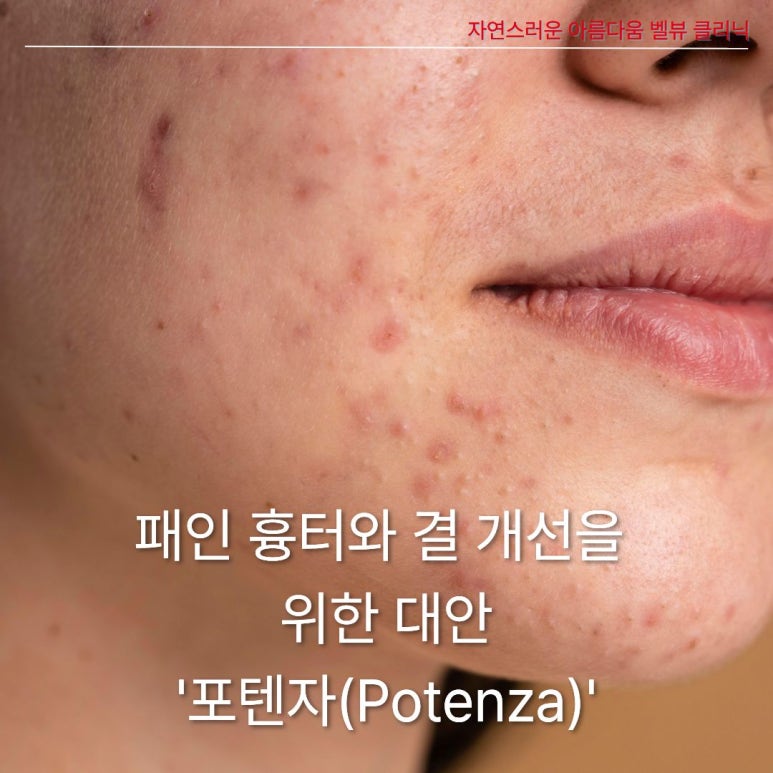 여드름 붉은 자국에 프락셀? 오히려 독이 되는 이유와 올바른 치료법 관련 이미지 4