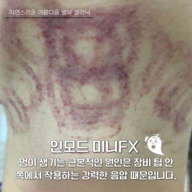 The Battle Between Microwaves and Radiofrequency: How to Choose a Customized Lifting Treatment for Your Face Shape [ONDA vs. InMode] image 5