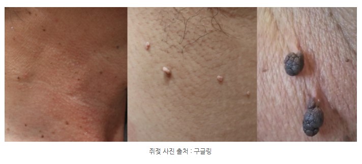 [Dr. Belleview Column 74.] Why You Shouldn’t Leave Skin Tags on Your Neck Alone image 1