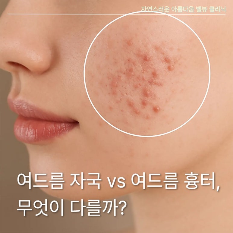 여드름 자국과 여드름 흉터 구별법, 프락셀을 맞으면 좋은 경우와 안 좋은 경우는? 관련 이미지 2