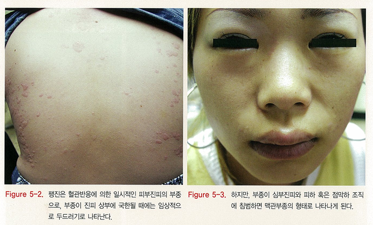 다양한 두드러기 종류 1탄 (알레르기성/ 만성특발성/ 한랭성/ 열성/ 피부묘기증 등) 관련 이미지 3