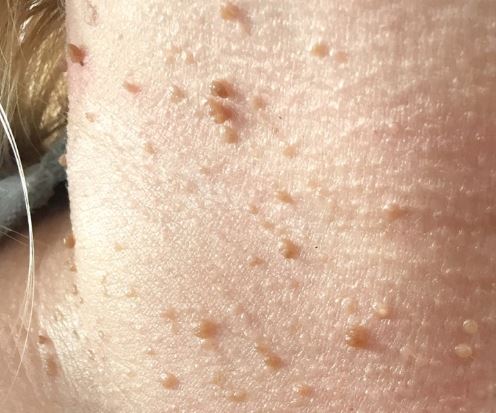 [Dr. Belleview Column 74.] Why You Shouldn’t Leave Skin Tags on Your Neck Alone image 7