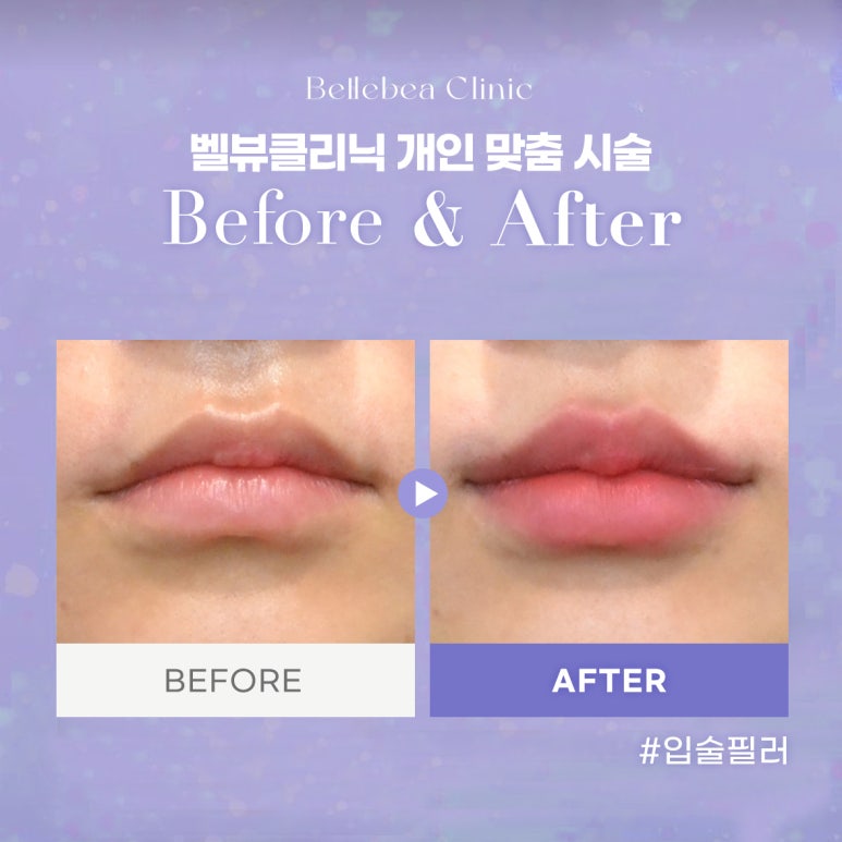 34. 벨뷰클리닉 입술필러 전후사진 관련 이미지 1