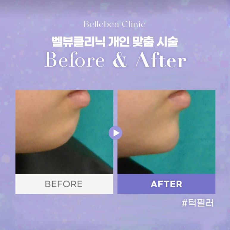 48. 벨뷰클리닉 턱 필러 전후사진 관련 이미지 1