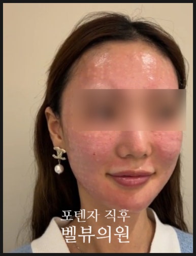 After Potenza: The Time When Your Skin Is Truly Rebuilt image 2