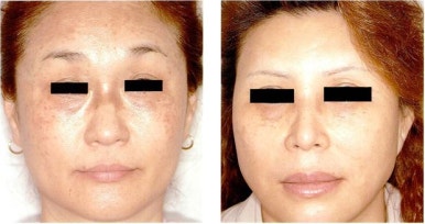 단순잡티가 아니라 난치성 색소질환이라고? 관련 이미지 3