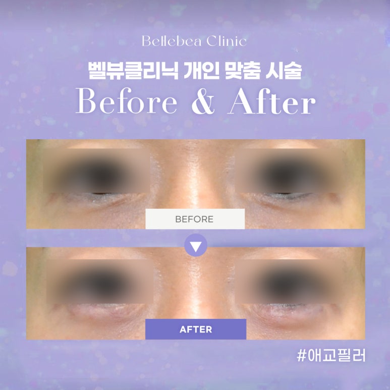 20. 강남역피부과 애교필러전후사진 애교필러후기 관련 이미지 1