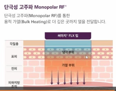 고주파 리프팅 장비 [써마지와 인모드 차이점] 관련 이미지 7