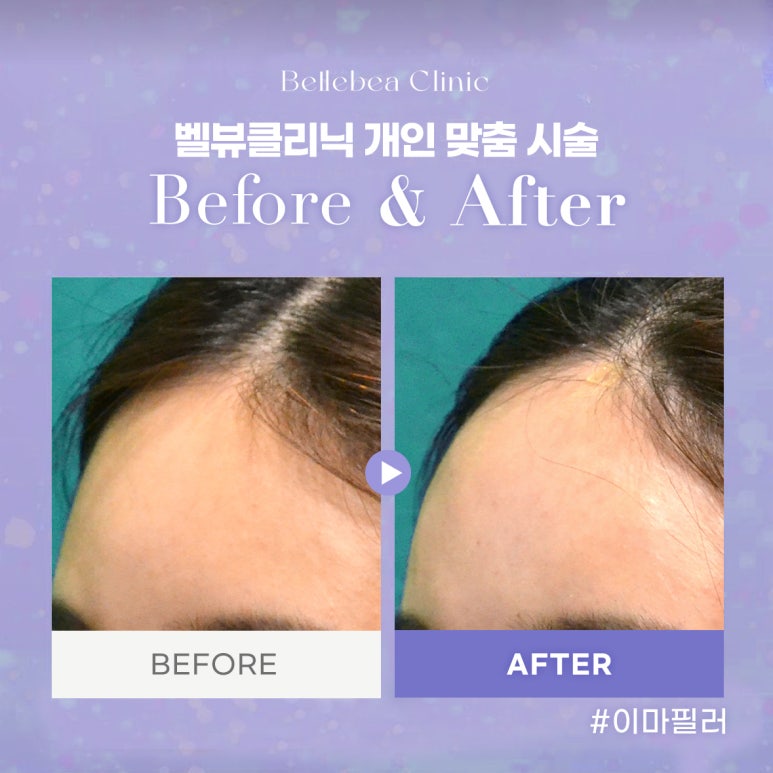 강남역피부과 이마필러전후사진 이마필러후기 관련 이미지 1