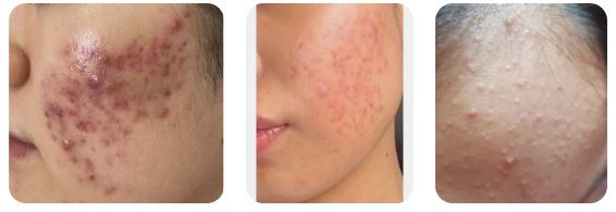 [Dr. Bellview Column 72.] Acne: Don’t Worry Anymore! Causes and Solutions by Type image 2
