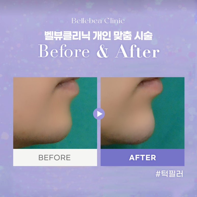 46. 벨뷰클리닉 턱 필러 전후사진 관련 이미지 1