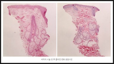 [닥터벨뷰 칼럼 86.]울쎄라(HIFU), 써마지(RF), 그리고 벨뷰에 새로 도입된 온다 리프팅 비교 관련 이미지 10