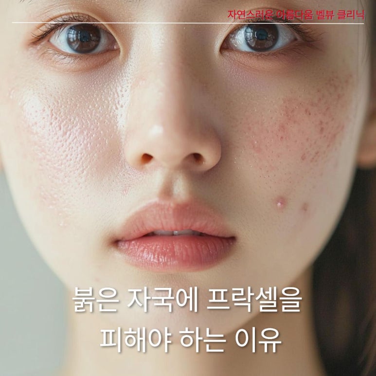 여드름 붉은 자국에 프락셀? 오히려 독이 되는 이유와 올바른 치료법 관련 이미지 3