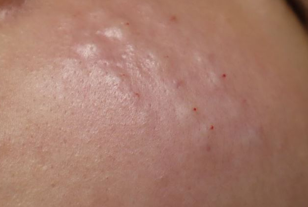 [Dr. Bellvue Column 71.] Comparison of Lizne and Rejuran image 3