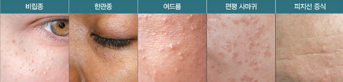 오돌토돌한 피부를 만드는 병변[ 쥐젖, 비립종, 한관종, 편평사마귀, 좁쌀여드름] 관련 이미지 3