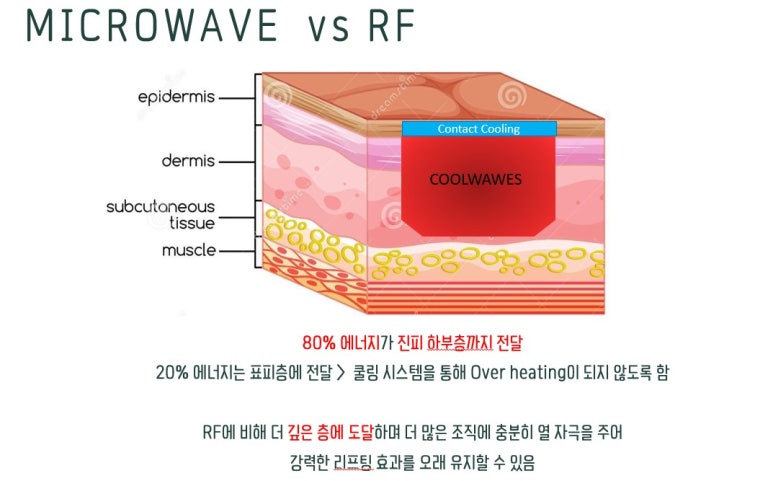온다 리프팅 그게 뭔가요? 극초단파와 스페셜한 핸드피스 관련 이미지 8