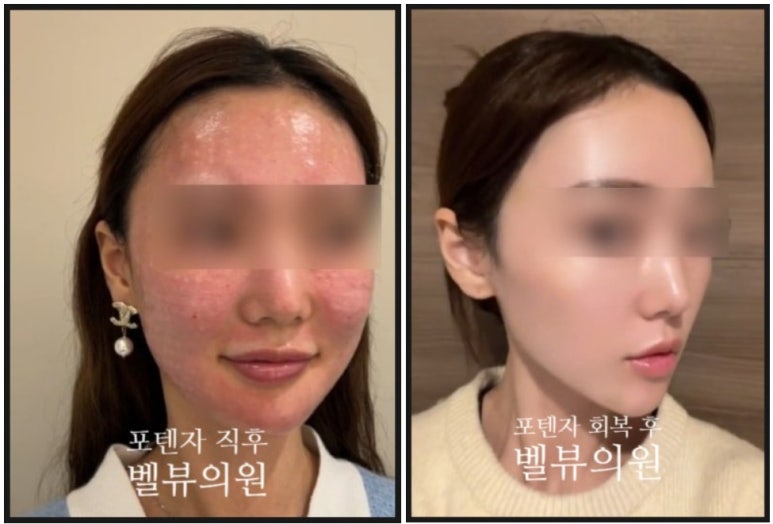 "솔직히 아픕니다. 그런데도 제가 매번 찾는 이유요?"| 벨뷰 원장님의 최애 레이저 & 3단계 나이트 루틴 관련 이미지 2