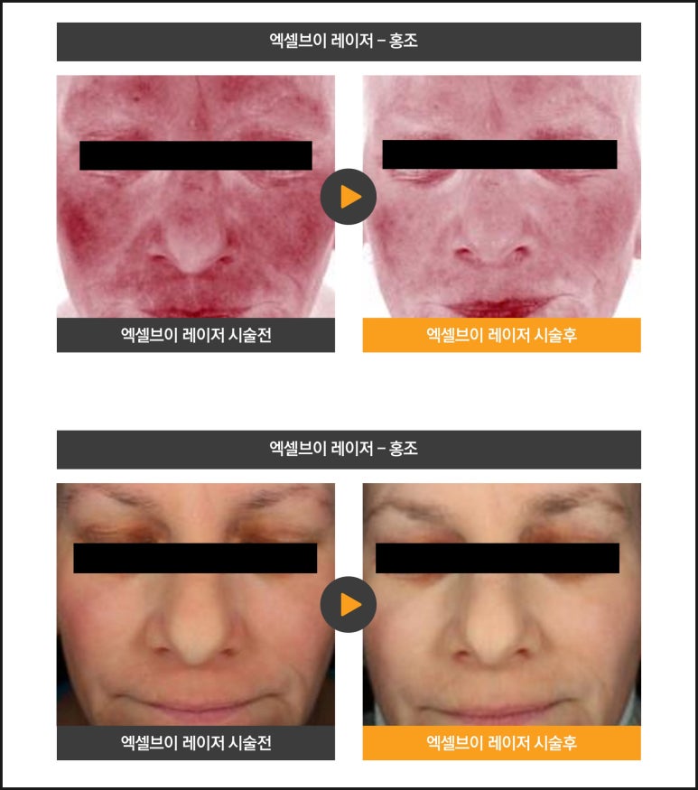 Causes of Vascular Dilation, a Case of Skin Flare-Up and Sensitivity After Facial Paralysis, and Excel V image 5
