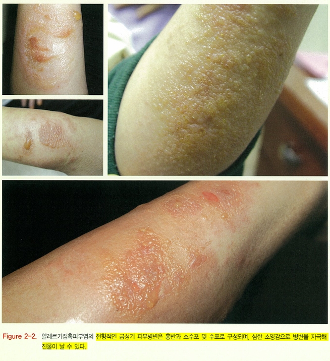 알레르기 접촉 피부염 / 자극 접촉 피부염 관련 이미지 2
