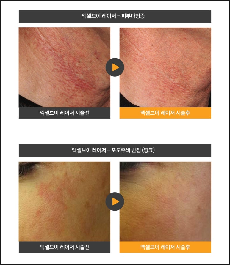 Causes of Vascular Dilation, a Case of Skin Flare-Up and Sensitivity After Facial Paralysis, and Excel V image 6