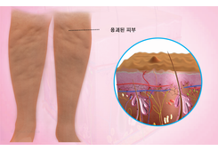 똘똘 뭉친 셀룰라이트로 고민해보셨나요? (feat. 노블쉐이프) 피부과에서 편하게 받는 셀룰라이트 치료 관련 이미지 5