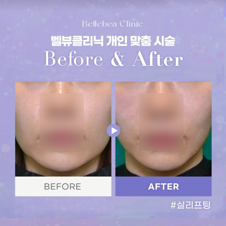 벨뷰클리닉 개인 맞춤 시술 관련 이미지 1