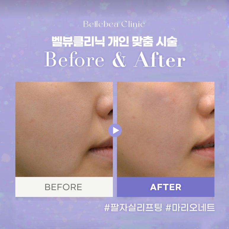 벨뷰클리닉 개인 맞춤 시술 관련 이미지 1