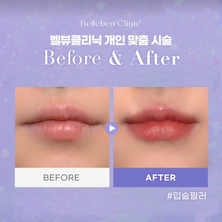 강남역피부과 입술필러전후사진 입술필러후기 관련 이미지 1