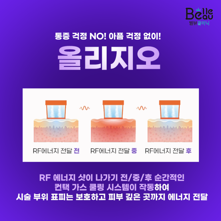 올리지오 리프팅 효과, 시술주기, 필요샷수 모두 알려드려요 관련 이미지 4