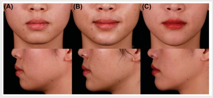 고급진 김지원 턱선이 부러워요! 한끗차이로 완성되는 세련미(턱끝필러) 관련 이미지 5