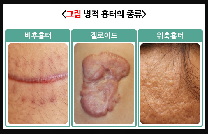 켈로이드 가족력 유전되는 이유와 비후성 흉터 비교 관련 이미지 4