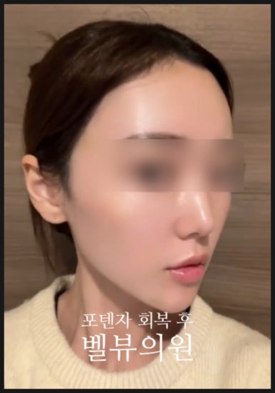 After Potenza: The Time When Your Skin Is Truly Rebuilt image 3
