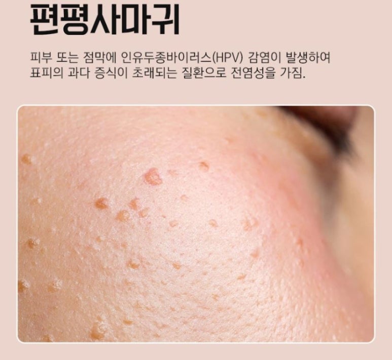 Smooth Skin with Laser Treatment for Flat Warts That Cause Skin Bumps image 2
