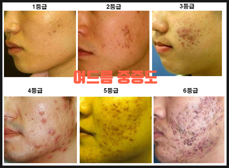 자꾸 모공이 커질 때는 어떤 피부과 시술이 좋을까? 마크뷰 정밀 진단 검사 받아보세요 관련 이미지 7