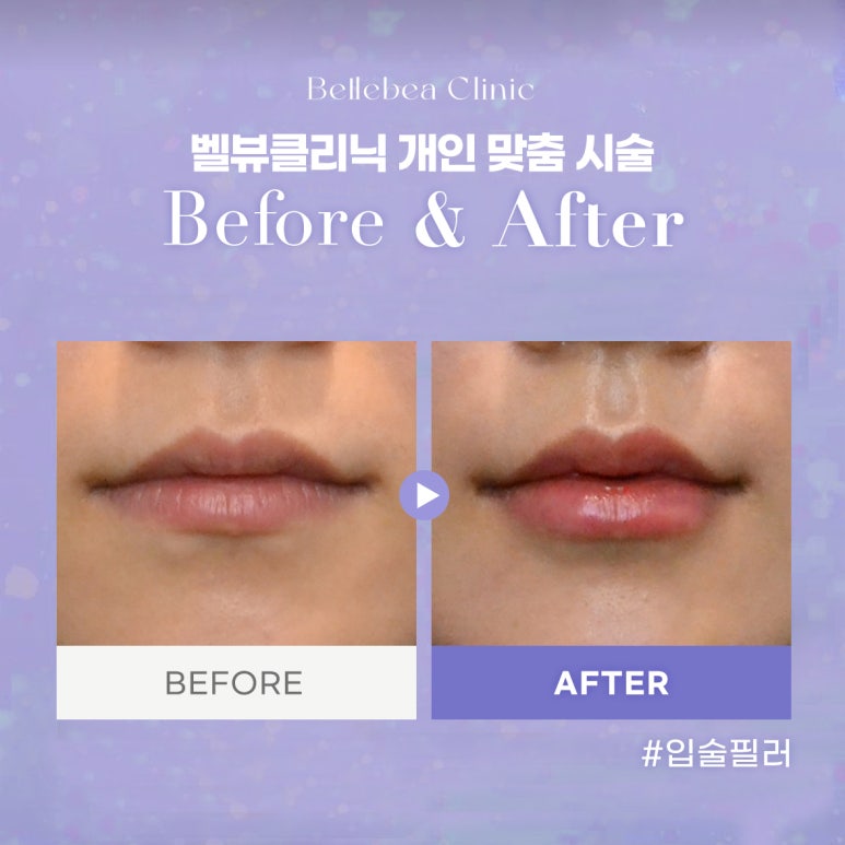 44. 벨뷰클리닉 입술필러 전후사진 관련 이미지 1