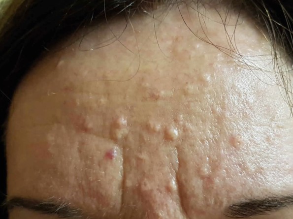 Bumps That Cannot Be Squeezed—Neither Skin Tags nor Acne: The Causes and Proper Treatment of ‘Sebaceous Hyperplasia’ image 2