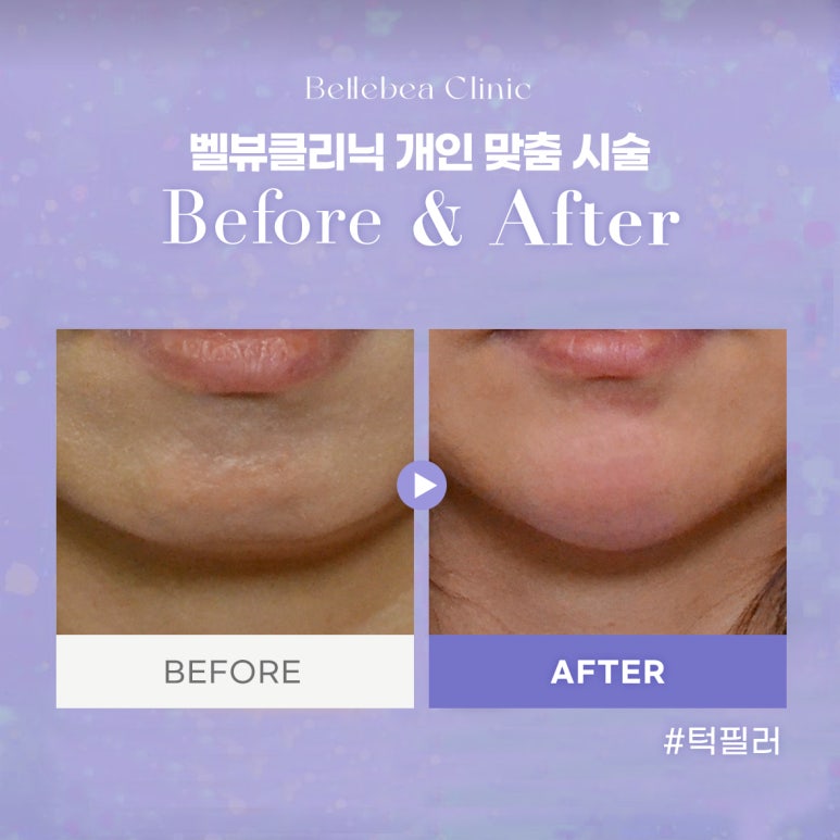 5. 강남역피부과 무턱필러전후사진 무턱필러후기 관련 이미지 1