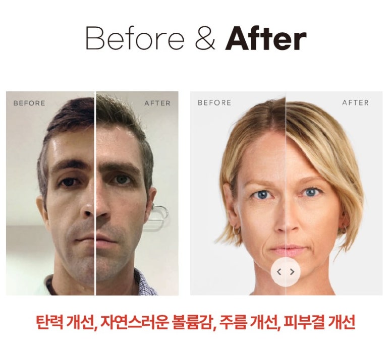 [닥터벨뷰 칼럼 55.] 확실하고 자연스럽게 피부 콜라겐을 채우는 방법 (1) 레디어스 관련 이미지 7