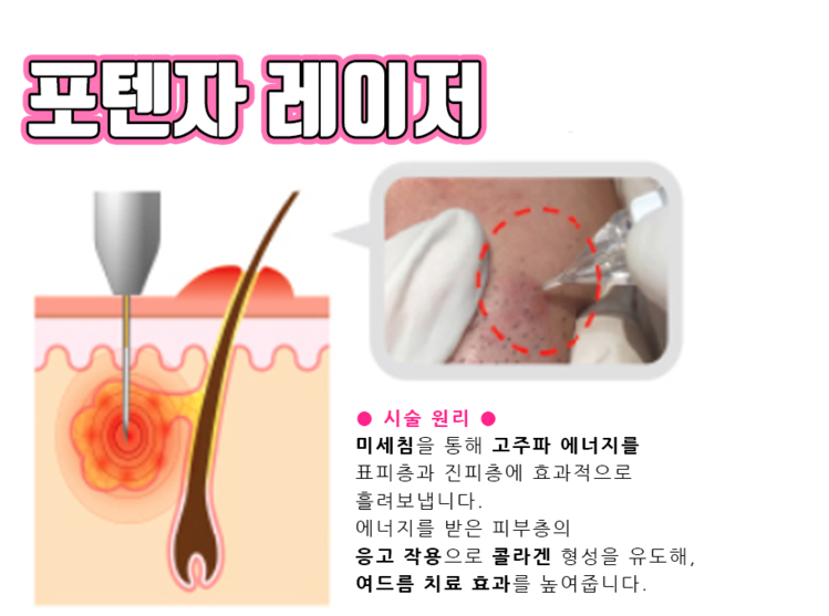 여드름 흉터 모공 해결사 [ 포텐자 + 쥬베룩 ] 관련 이미지 7