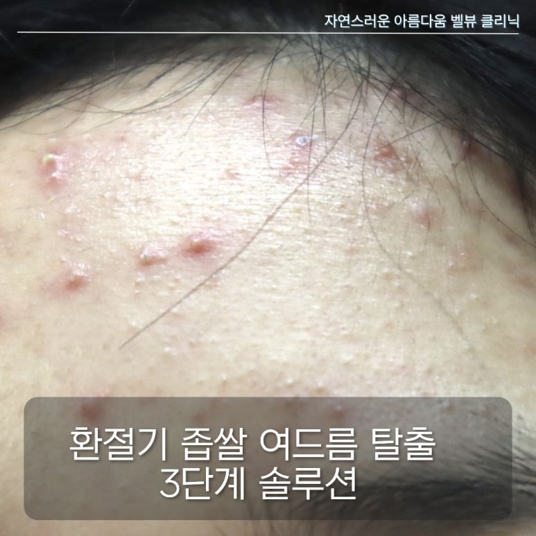 가을&middot;겨울철 유독 올라오는 좁쌀 여드름, 각질 때문일까 피지 때문일까? 관련 이미지 3