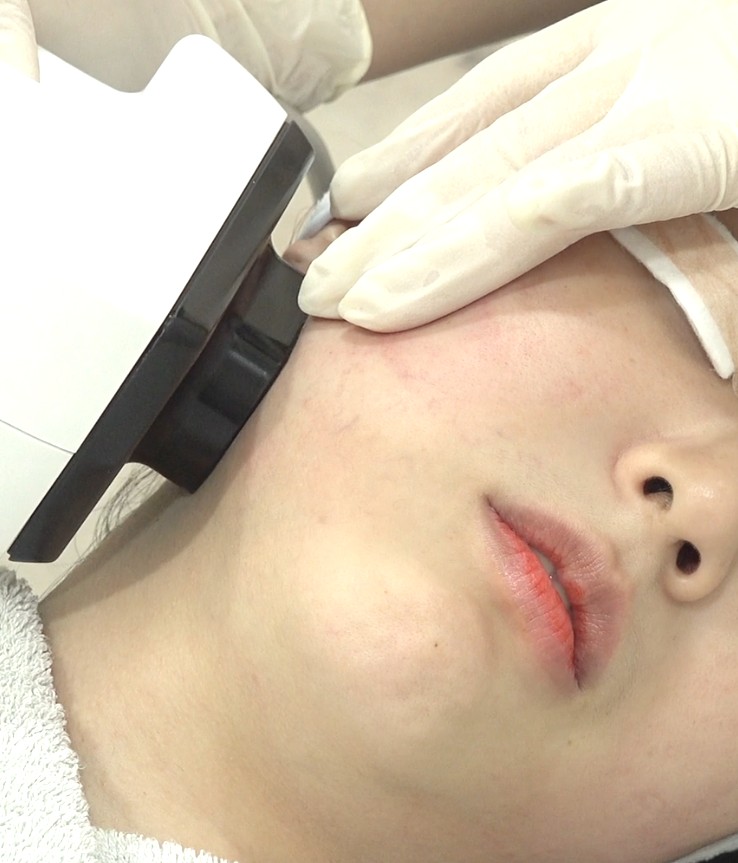 [닥터벨뷰 칼럼 94.] 굴곡진 땅콩형 얼굴, 무조건 당기는 리프팅이 정답이 아닌 이유 관련 이미지 3