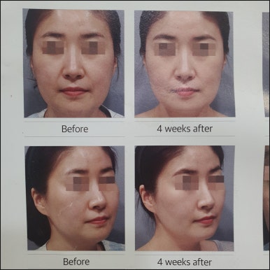 [Dr. Bellview Column 90.] Luxury Skin Completed by a Hair’s Breadth of Difference: Why the Dosage of Skin Boosters Determines the Details of the Result image 3