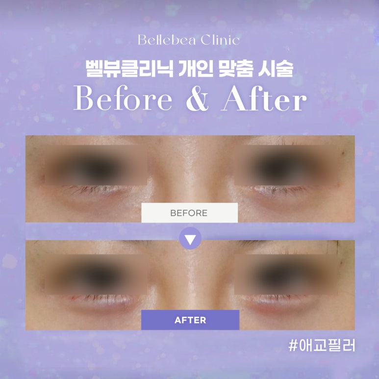 23. 강남역피부과 애교필러전후사진 애교필러후기 관련 이미지 1
